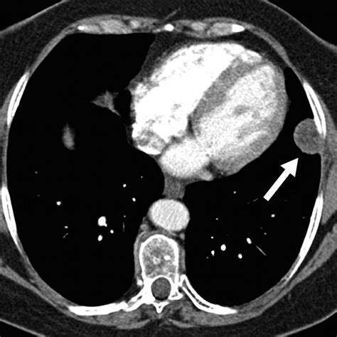 Solid Pleural Lesions Ajr