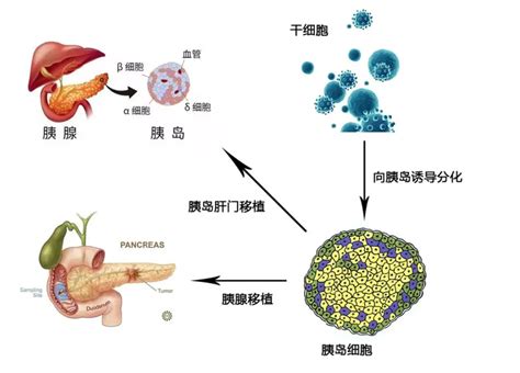 糖尿病干细胞治疗 中科西部干细胞