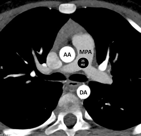 Computed Tomography Pulmonary Angiography Ctpa With Suboptimal