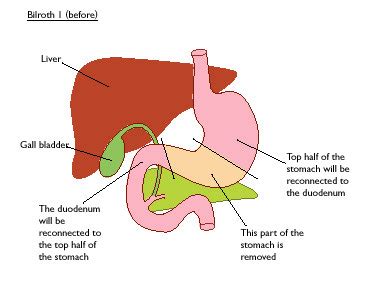 Surgical Procedures for Primary GIST | GIST Support International