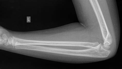 File Normal Elbow Radius And Ulna X Ray Year Old Radiopaedia