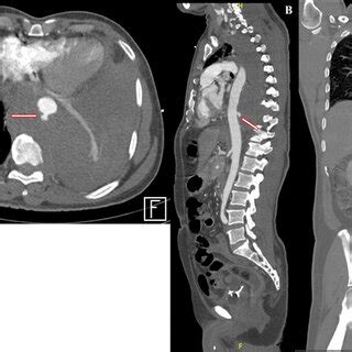 Computed tomography (CT) aortogram of the thoracic aorta Axial section ...