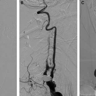 Postprocedural Angiography A Anteroposterior And B Lateral Right