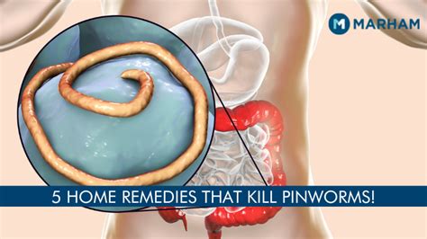 Pinworms In Humans