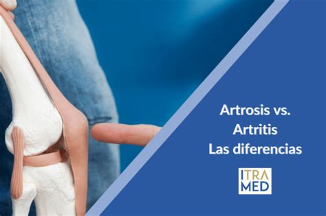 La Artrosis Y La Artritis Qu Es Itramed