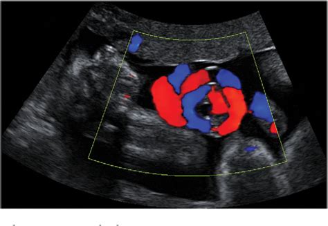 Figure From Prenatal Detection And Obstetric Management Of True