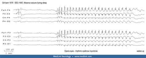 Focal Onset Generalized Absence Seizures Medlink Neurology