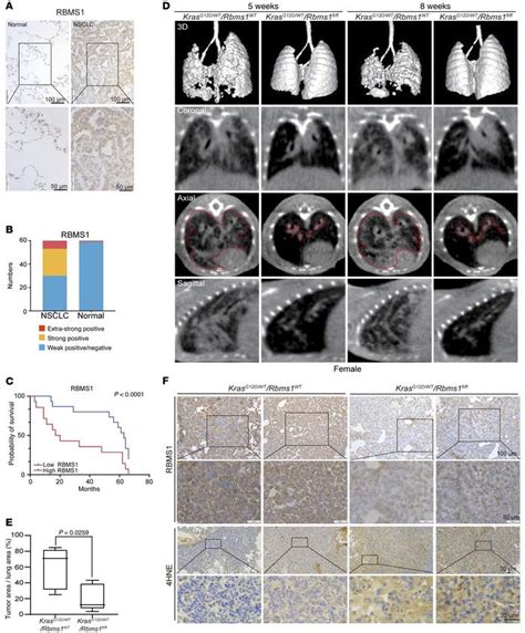 Jci Rbms Regulates Lung Cancer Ferroptosis Through Translational