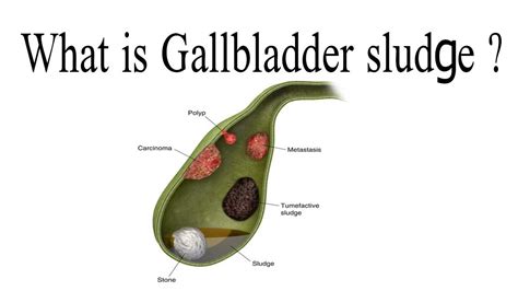 What Is Gallbladder Sludge YouTube