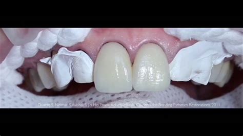 Dental Clone Dise O De Sonrisa Madrid Youtube