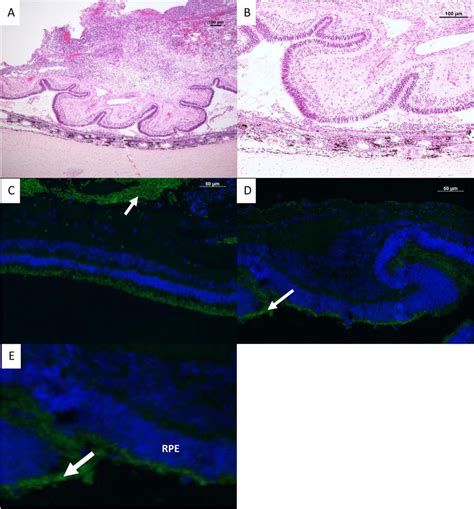 Histopathological Staining Of The Retina In An Eye With Pvr A Hande