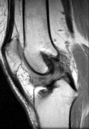 Cyclops Lesion Knee Radiology Reference Article Radiopaedia Org