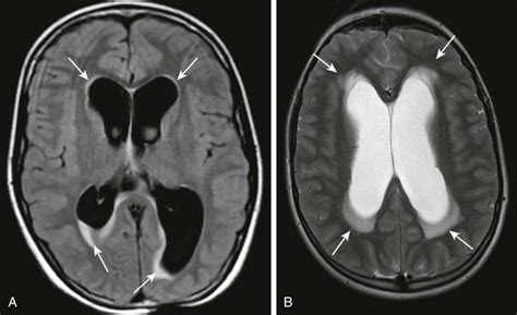 Hydrocephalus Radiology Key