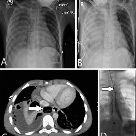 A X Ray Of A Patient With Esophageal Perforation With Right Pleural