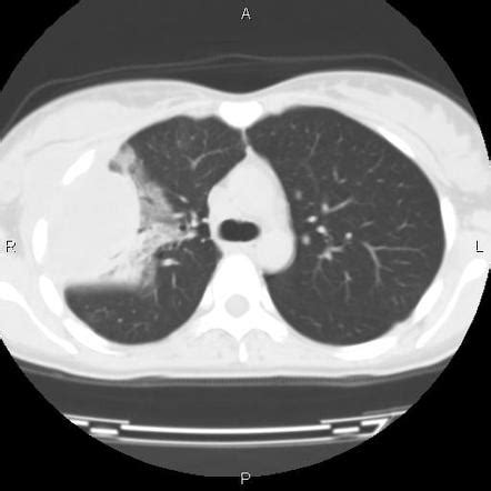 Epithelioid Sarcoma Pulmonary Metastases Radiology Case Radiopaedia Org