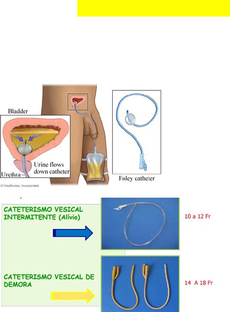 Retirada De Sonda Vesical De Demora Foley Masculina