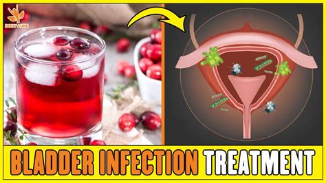 Top 6 Herbal Remedies For Bladder Infection Treat Uti At Home Youtube