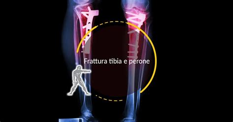 Frattura Tibia Tibia Fibular Fracture Fotos Und Bildmaterial In Hoher