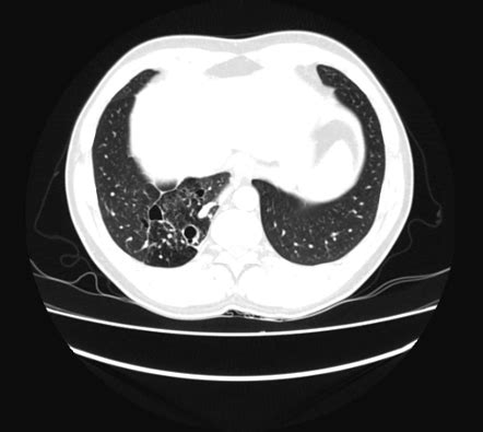 Intralobar Pulmonary Sequestration Radiology Case Radiopaedia Org