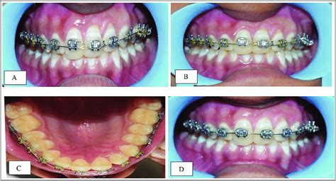 Clinical Intraoral Images Demonstrating The Treatment Progress A The Download Scientific