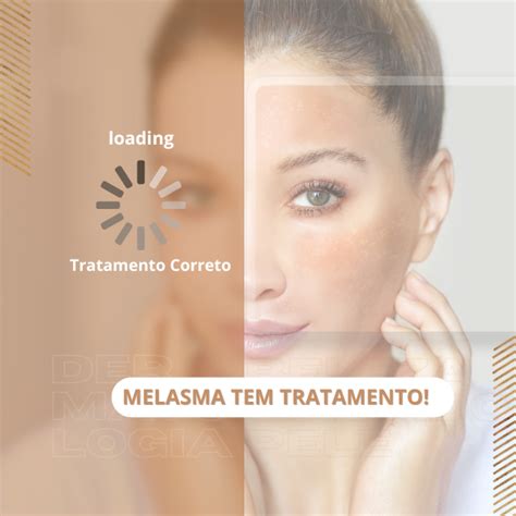 Correta forma de tratar o Melasma Z D Saúde Estética Integrativa