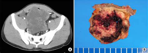 Figure 1 From Clinicopathologic Features And Clinical Outcomes Of