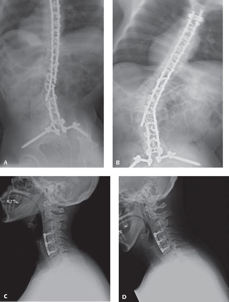 Spinal Imaging for Pseudarthrosis | Musculoskeletal Key