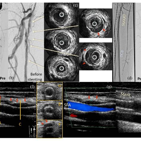 Seventy Two Year Old Male Treated With Viabahn Stent Graft A Viabahn