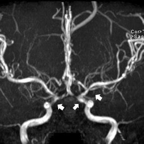 Magnetic Resonance Angiography Image Showing Multifocal Narrowing In