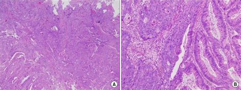 Histopathological Views Reveal Adenosquamous Carcinoma Of The Download Scientific Diagram