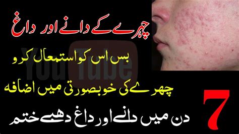 Chehre Ke Dane Khatam Karne Ka Desi Noskha Face Pimples Treatment At