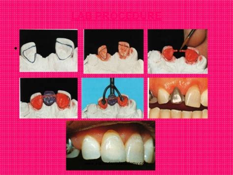 Resin Bonded Bridges Certified Fixed Orthodontic Courses By Indian De