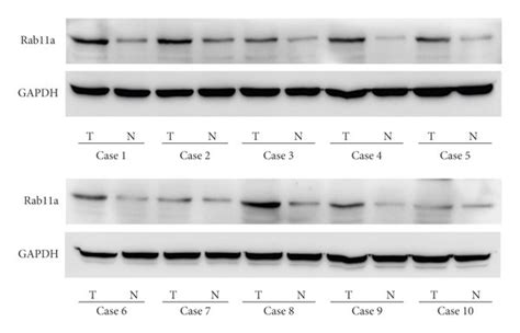 Rab11a Expression Is Increased In Gastric Cancer Tissues A Negative