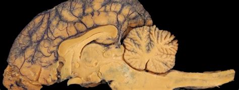 The cerebellum, cognition and emotions – Mat Boulé, Osteopath, Posturologist, Educator