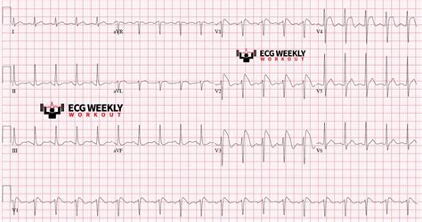 Literature Review: Brugada Syndrome – ECG Weekly