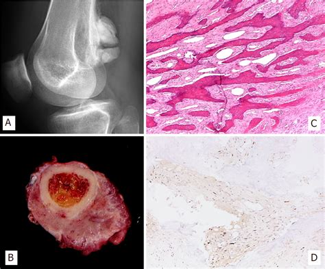 Primary Malignant Tumors Of Bone Surface A Review With Emphasis In