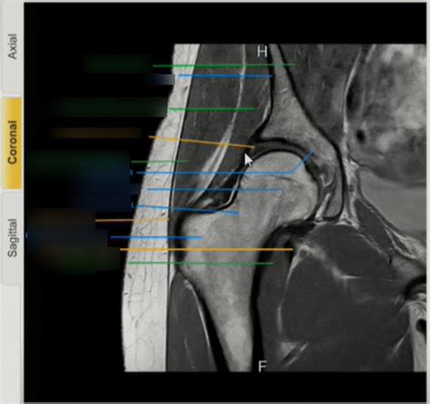 Coronal Hip MRI 7 Diagram | Quizlet