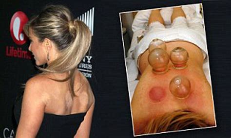 Cupping Therapy Artofit