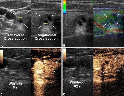 Multimodality Us Versus Thyroid Imaging Reporting And Data System