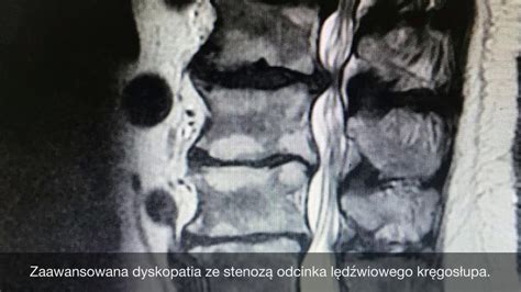 Dyskopatia I Przepuklina Kr Ka Jak Wygl Daj Na Rezonansie