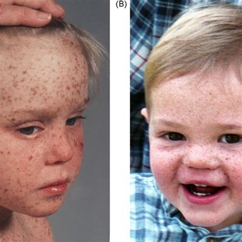 An Abnormalities Form In Dna Xeroderma Pigmentosum Xp