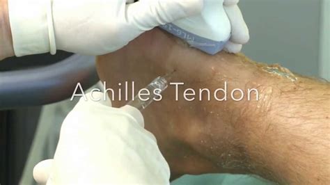 OSTENIL Tendon Injection 1 4 Achilles Tendon YouTube