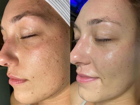 The Amazing Transformation Hydrafacial Before And After