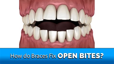 Braces Before And After Open Bite