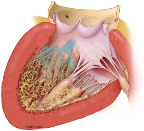 His Purkinje System With Insulation Of The Proximal Portion And Loss Of