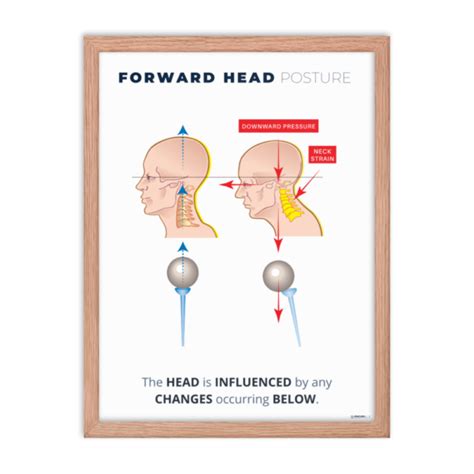 Forward Head Posture Correction Framed Poster