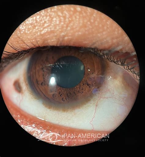 Racial Melanosis And Conjunctival Nevus Sociedad Panamericana De