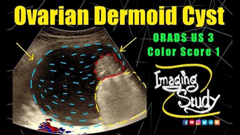 Dermoid Ovarian Cyst Ultrasound