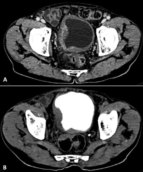 Metastatic Squamous Cell Carcinoma Urinary Bladder Coexisting With Tuberculosis In Pelvic Lymph