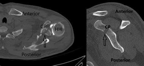 Figure 2 From Arthroscopic Management Of A Coracoid Fracture Associated With Acromioclavicular